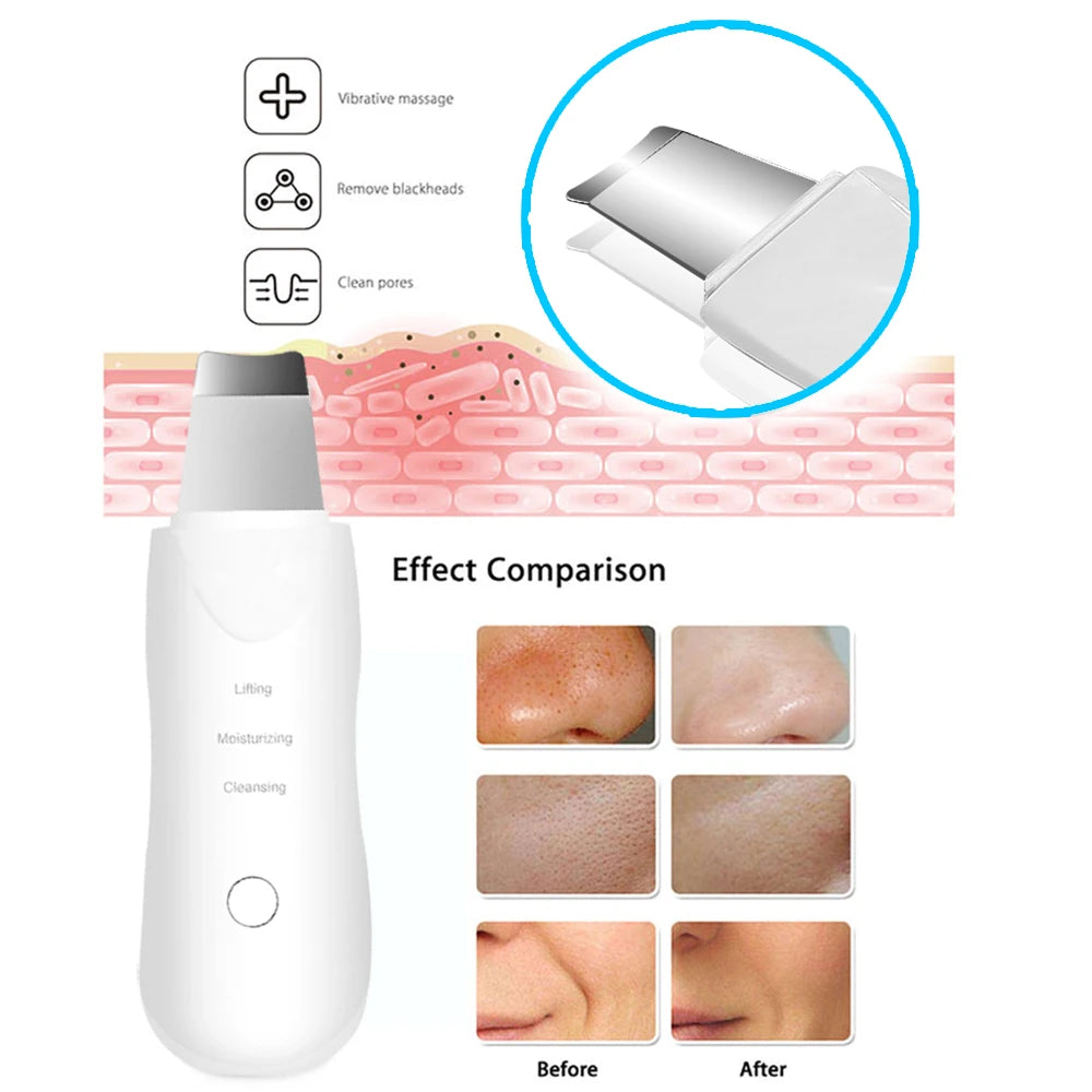 Espátula Ultrasónica Facial – Removedor de Puntos Negros y Masajeador | Tu Belleza & Tu Mascota
